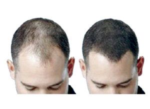 Vista superior comparativa de un hombre mostrando a la izquierda adelgazamiento y calvicie visible y a la derecha mayor densidad y cobertura capilar, presentación oficial en alta calidad.