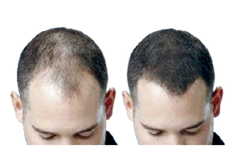 Vista superior comparativa de un hombre mostrando a la izquierda adelgazamiento y calvicie visible y a la derecha mayor densidad y cobertura capilar, presentación oficial en alta calidad.