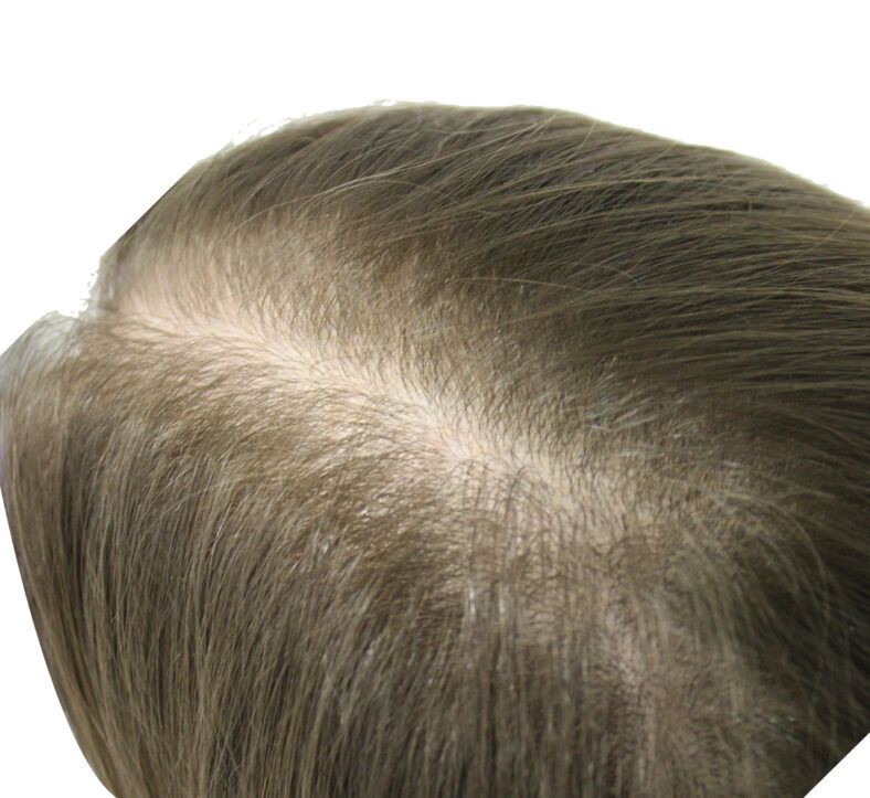 Vista cenital de un cuero cabelludo con cabello castaño claro y una raya central con notable adelgazamiento del pelo, imagen para uso 'profesional'.