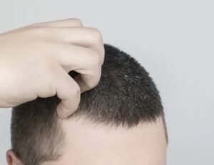Mano que rasca la coronilla de una persona con cabello muy corto y pequeñas escamas visibles sobre el cuero cabelludo, apta para ilustrar servicios de peluquería.