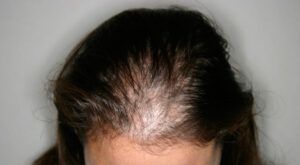 Primer plano de la zona frontal del cuero cabelludo con cabello ralo y áreas de cuero descubierto, iluminado de forma profesional y con composición directa.
